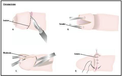 Consider, How do they circumcise adults excellent How do they circumcise adults